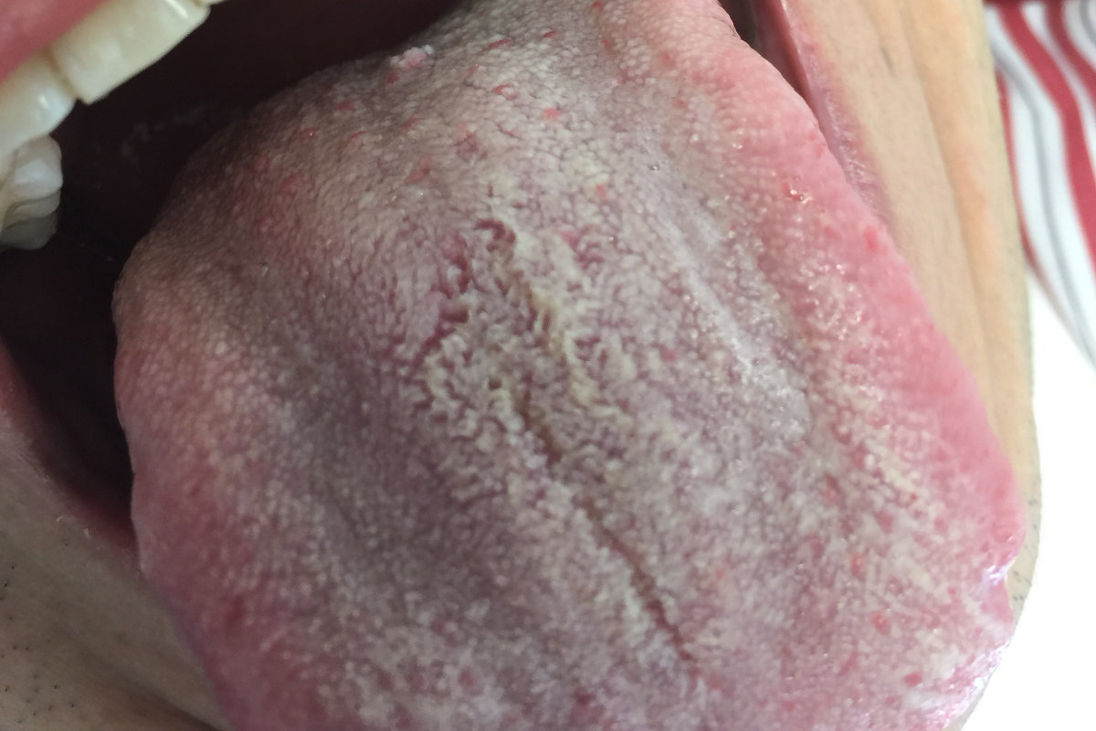 VPH Condilomas en la lengua